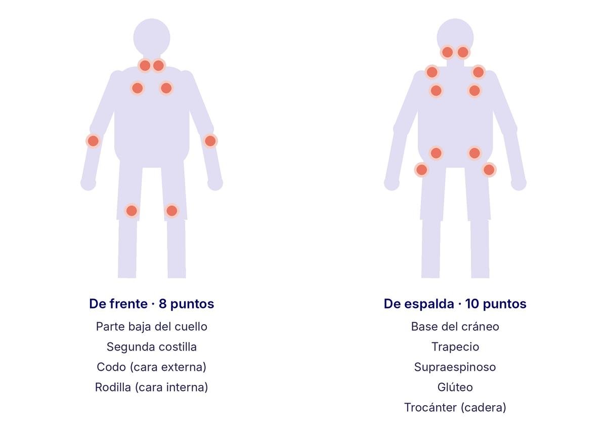 Mapa de los 18 puntos dolorosos de la fibromialgia: 8 de frente (parte baja del cuello, segunda costilla, codo y rodilla) y 10 de espalda (base del cráneo, trapecio, supraespinoso, glúteo y trocánter).